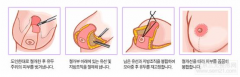 韩国乳房下垂提升手术【过程、案例图、副作用