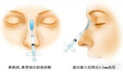 脂肪隆鼻、玻尿酸隆鼻介绍