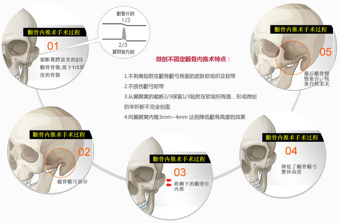 上海名航俞良钢磨颧骨优势